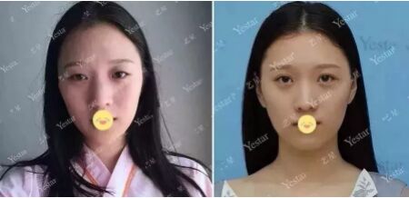 小眼睛,单眼皮的眼睛,竟然可以美成这样,感谢北京艺星做的双眼皮