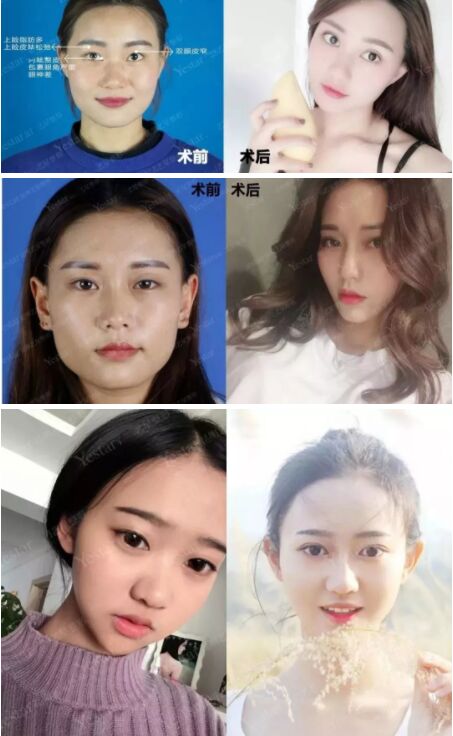 小眼睛,单眼皮的眼睛,竟然可以美成这样,感谢北京艺星做的双眼皮