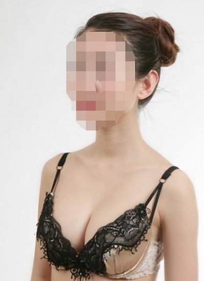 汤张洪【宁波艺星】自体脂肪丰胸案例分享~动感胸部让您美丽无忧