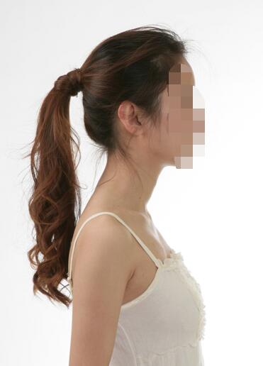 汤张洪【宁波艺星】自体脂肪丰胸案例分享~动感胸部让您美丽无忧