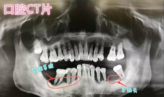年过四十的我在扬州贝恩的种植牙经历