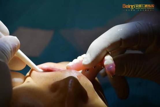 年过四十的我在扬州贝恩的种植牙经历