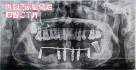 年过四十的我在扬州贝恩的种植牙经历