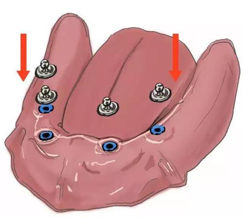 青岛全口种植牙 选择优诺博士口腔医院