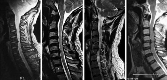 颈椎牵引最好躺着做