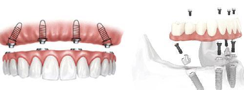 缺牙人士的福音 青岛全口种植牙技术