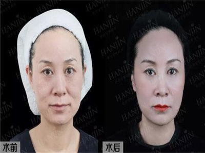 昆明除皱哪家医院好:年轻面容由韩辰打造,韩辰值得您的信赖