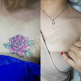 洗博士皮秒洗纹身带给肌肤重生的可能