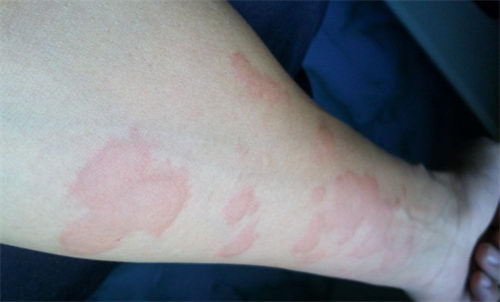 荨麻疹怎么治好?-我已治好我来说