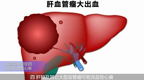 荆州文杰医院孔强院长针对血管瘤并发症发表看法