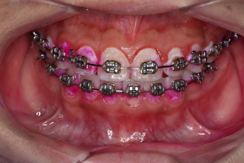 牙齿,需要仪式感