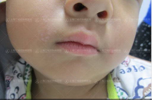 别再让白癜风耽误孩子了!看看上海江城皮肤病医院专家怎么说?