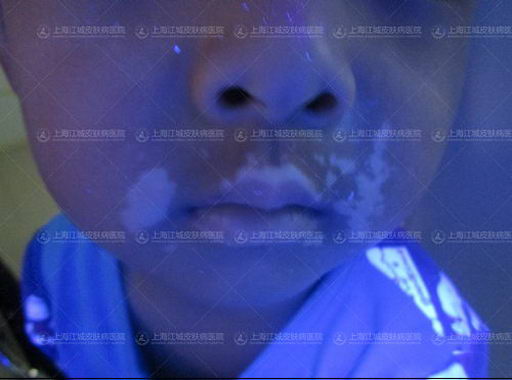 别再让白癜风耽误孩子了!看看上海江城皮肤病医院专家怎么说?