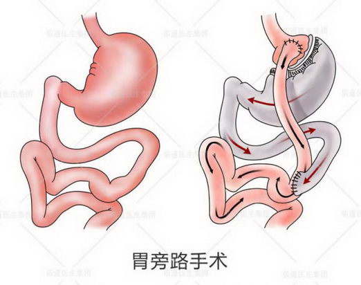 吴良平医生:胃旁路减重手术可重建健康饮食习惯