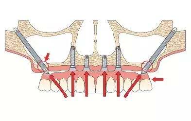 无牙颌也能种牙?暨大穗华穿颧种植技术问鼎种植牙技术制高点