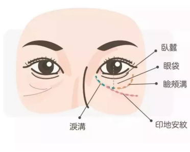 北京伊美尔医疗医院:泪沟的形成原因
