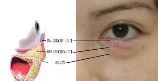 北京伊美尔医疗医院:泪沟的形成原因