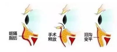 北京伊美尔医疗医院:泪沟的形成原因