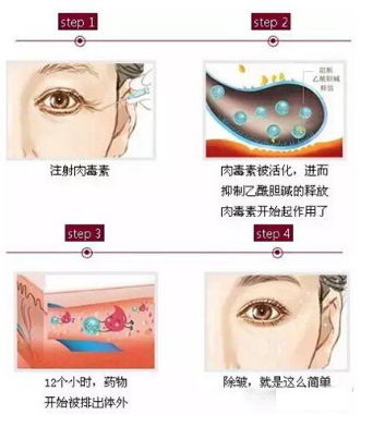 北京伊美尔紫竹医院:肉毒素注射除皱怎么样