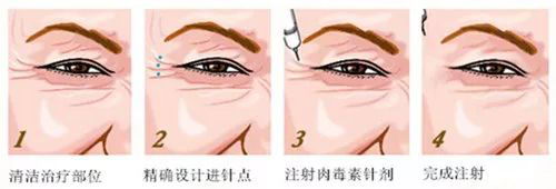 北京伊美尔紫竹医院:肉毒素注射除皱怎么样