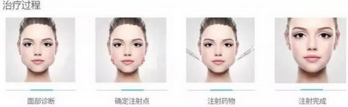 北京伊美尔紫竹医院:肉毒素注射除皱怎么样