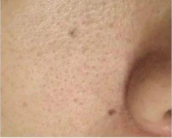 北京伊美尔爱康医院:超微小气泡是什么