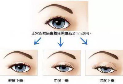 上海玫瑰医院双眼皮手术贵吗? 为您的美丽幸福护航