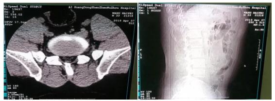 七尺男儿深受腰椎病困扰,五洲医院助其走上康复之路