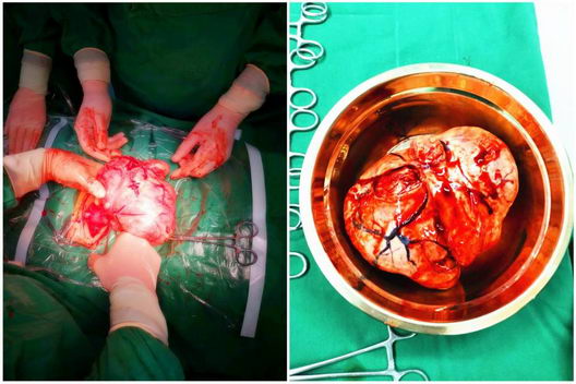 龙田金秋开展医联体技术交流 顺利完成子宫多发肌瘤剔除与取环术