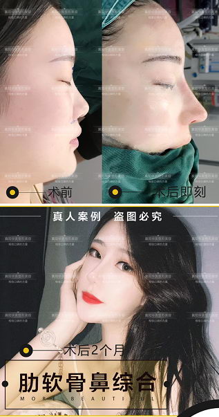 鼻子丑的人一定长得不好看!襄阳华美隆鼻特色大公开