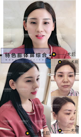 鼻子丑的人一定长得不好看!襄阳华美隆鼻特色大公开