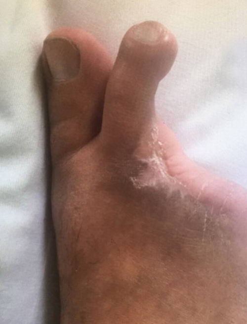 专家提醒 赶紧行动起来!绝对不是危言耸听,脉管炎再拖下去就要截肢了!