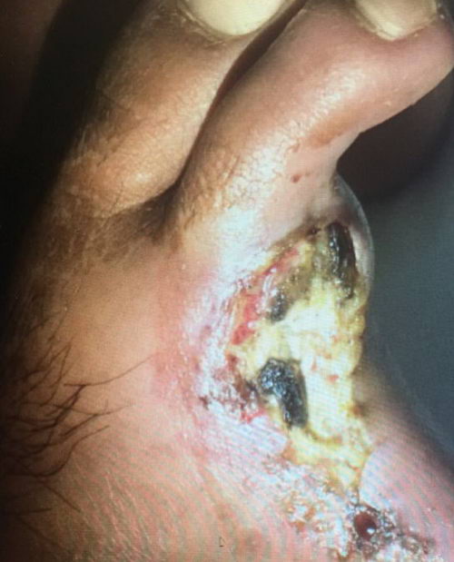 专家提醒 赶紧行动起来!绝对不是危言耸听,脉管炎再拖下去就要截肢了!