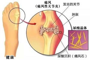 诱发痛风的原因_重庆黄泥磅医院专治痛风