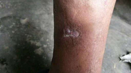 刘继前教授得了老烂腿怎么办?中西医结合治疗让患者重获新生