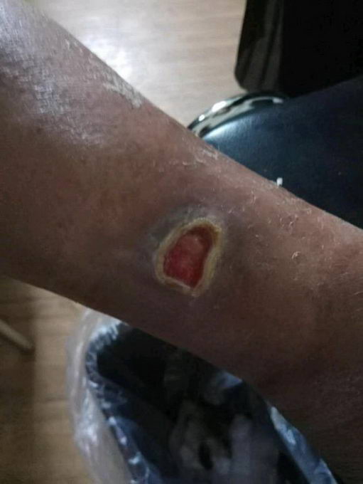 刘继前教授得了老烂腿怎么办?中西医结合治疗让患者重获新生