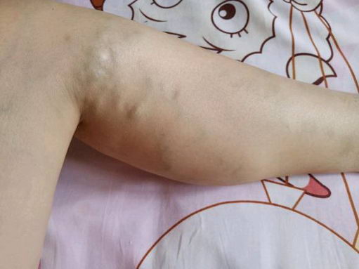 董田林教授轻松解决静脉曲张,去掉腿上的“小蚯蚓”!