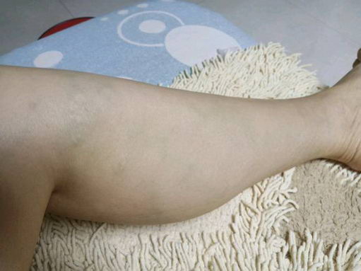 董田林教授轻松解决静脉曲张,去掉腿上的“小蚯蚓”!