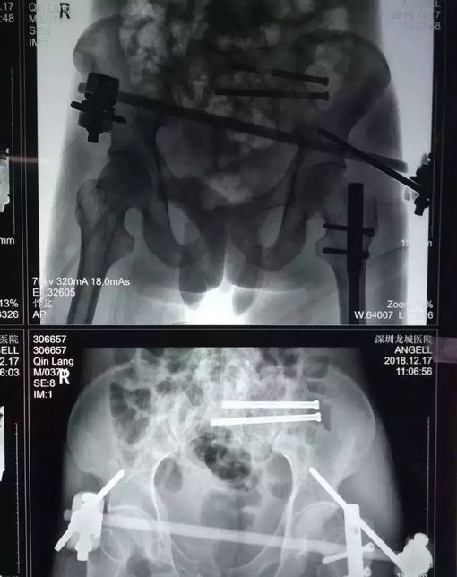 男子被卡车压伤全身多处粉碎骨折,深圳龙城医生妙手施救获赞誉