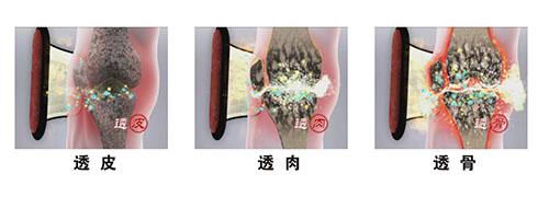 大连华联善古堂怎么治骨刺 中药外敷不吃药