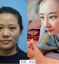 北京英煌医疗美容案例王勋隆鼻面部打造
