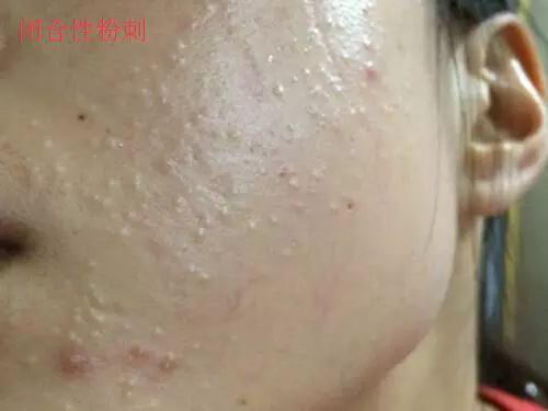 出现闭合性粉刺的原因,北京伊美尔幸福医院解答