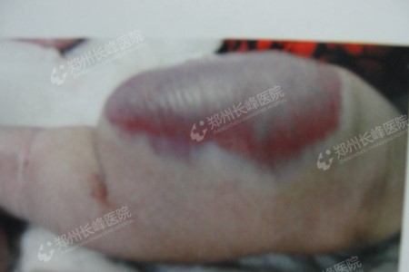 你知道怎么判断海绵状血管瘤这种疾病吗?郑州长峰医院告诉您