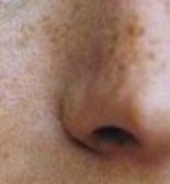 ��������������ҽԺ�������Ƥ����һ��Ч���ȽϺ�