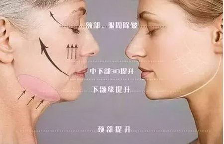 抗衰应该选择什么医美项目,北京伊美尔爱康医院解答