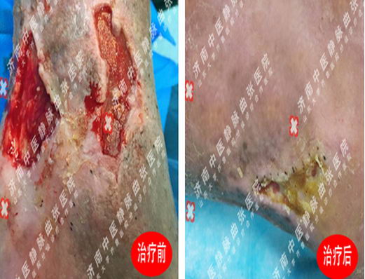 微动力负压引流技术无需引流加快老烂腿创面愈合