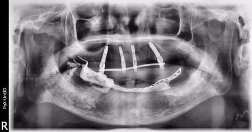 77ȱŶ꣬ȷʥǻall-on-4ֲػڸ