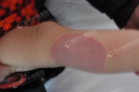 郑州长峰血管瘤医院讲述关于混合型血管瘤患者平常需要注意的事项的问题