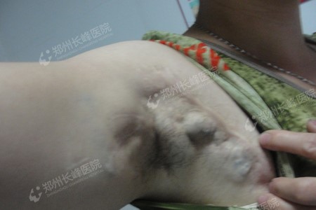 ֹ۵̬ȥƺ״Ѫ֣ݳѪҽԺ