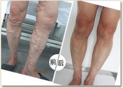 静脉曲张济南哪个医院比较好